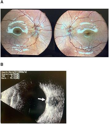 Optic Nerve Drusen Is Highly Prevalent Among Children With Pseudotumor Cerebri Syndrome